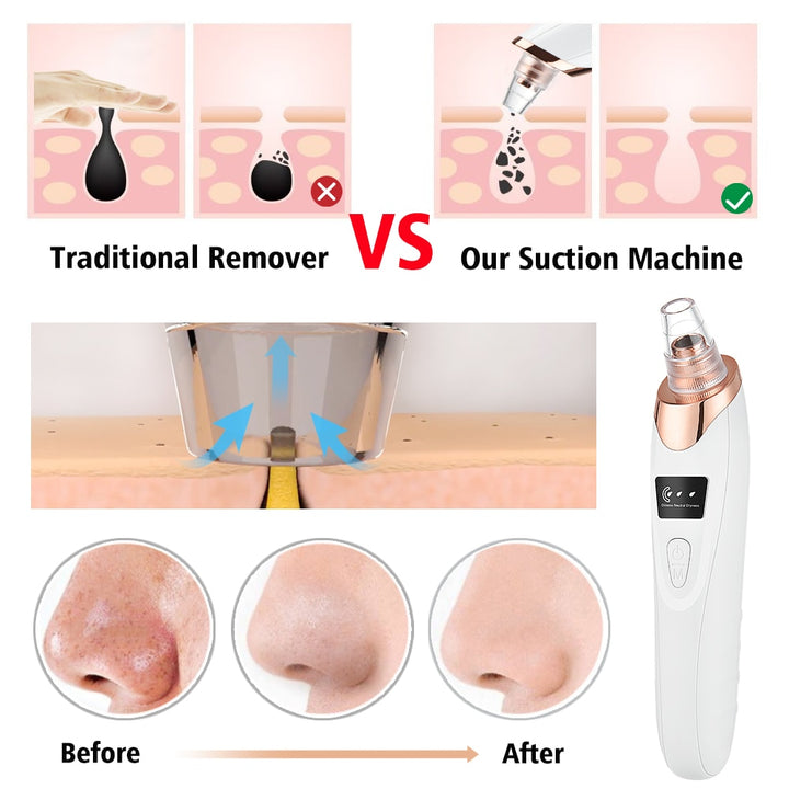 Blackhead Remover Vacuum Pore Cleaner Blue Sky